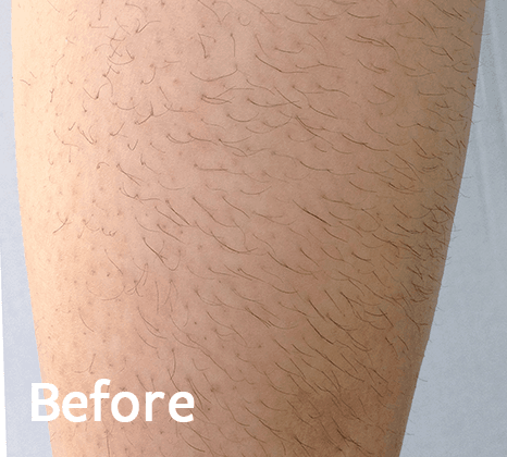 Diolaexl Hair Removal Treatment