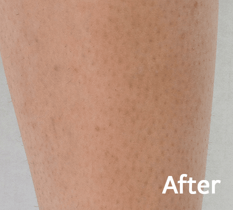 Diolaexl Hair Removal Treatment
