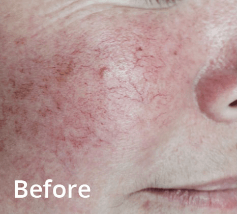 Lumecca Laser Skin Treatment