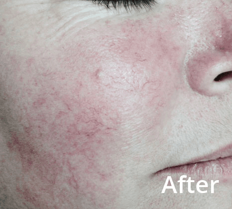 Lumecca Laser Skin Treatment