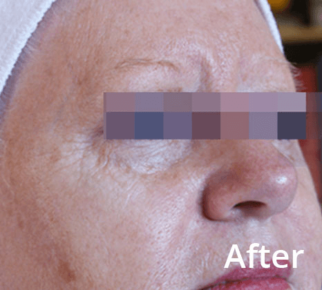 Lumecca Laser Skin Treatment