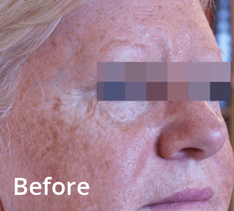 Lumecca Laser Skin Treatment