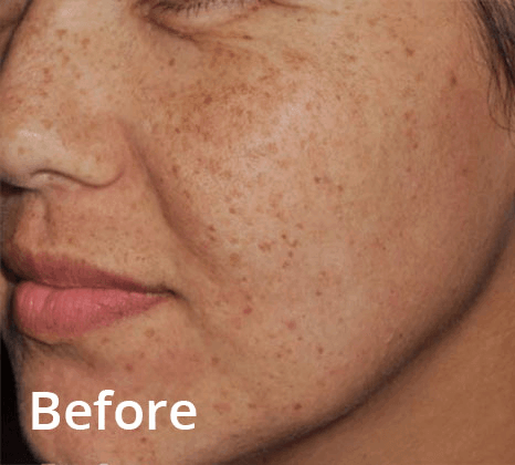 Lumecca Laser Skin Treatment
