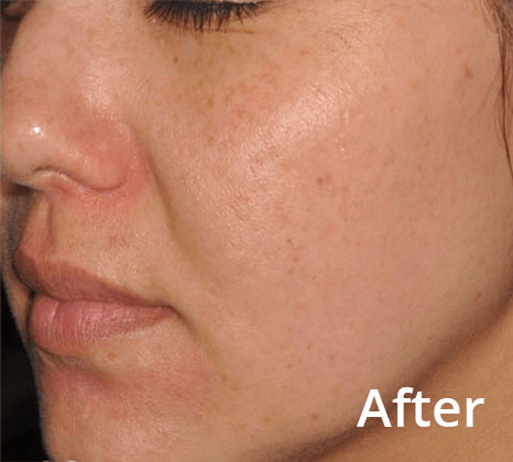 Lumecca Laser Skin Treatment