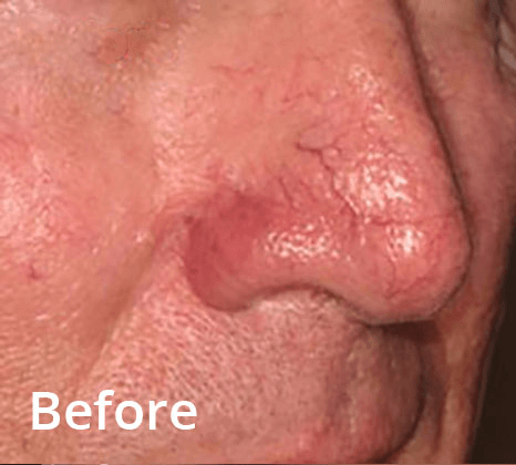 Lumecca Laser Skin Treatment