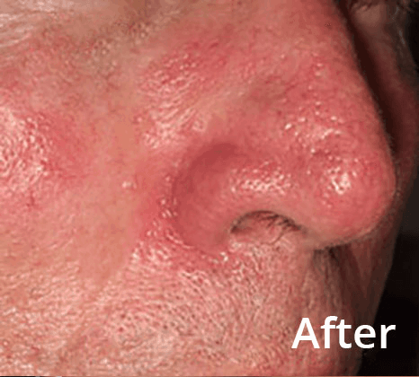 Lumecca Laser Skin Treatment