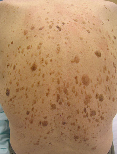 Botox for Melasma Treatment