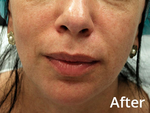 Morpheus8 Laser Skin Treatment