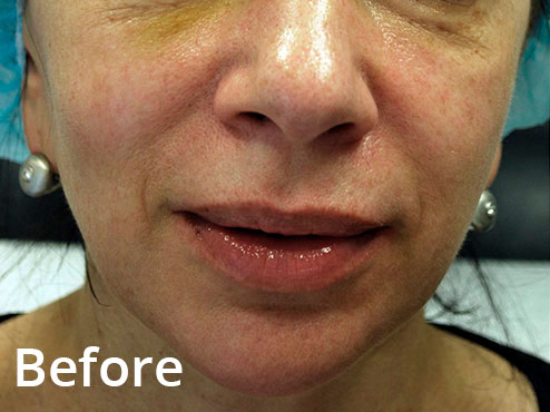 Morpheus8 Laser Skin Treatment