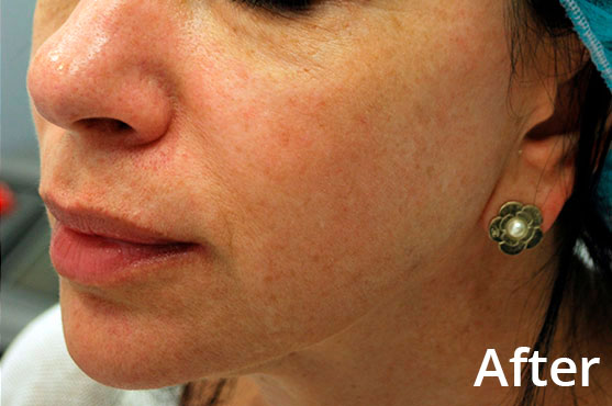Morpheus8 Laser Skin Treatment