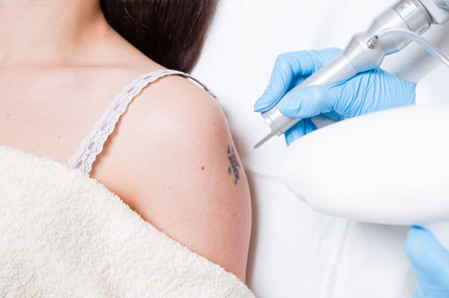 Tattoo Removal, Get Rid of Unwanted Tattoos