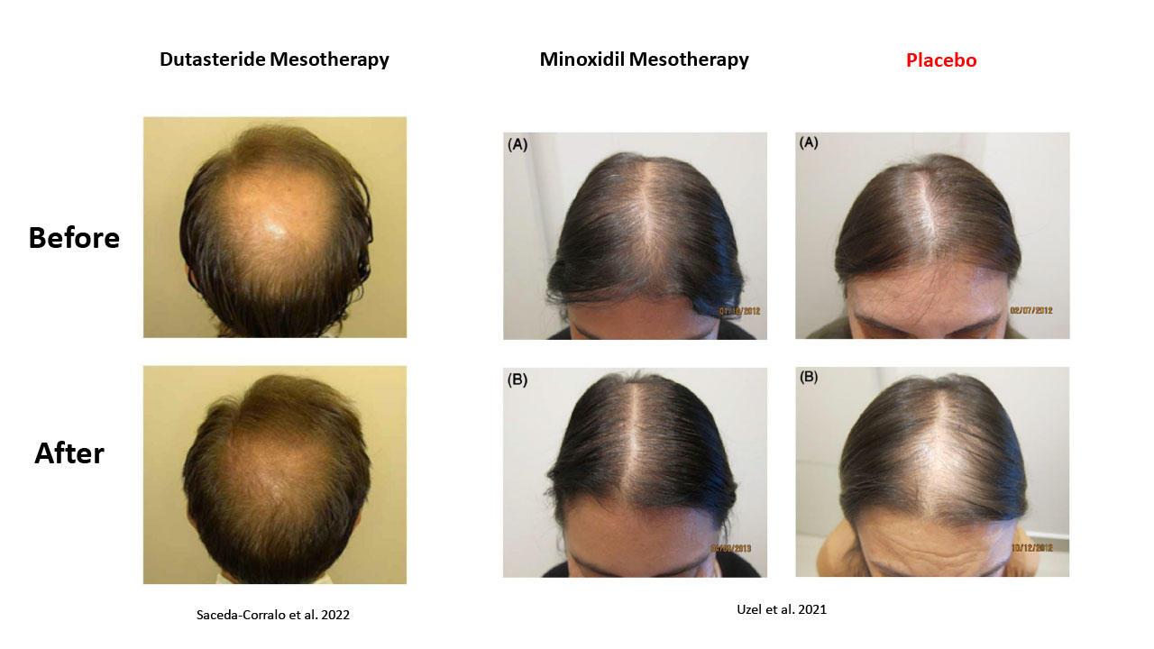 Take the Next Step Toward Hair Restoration Take the Next Step Toward Hair Restoration